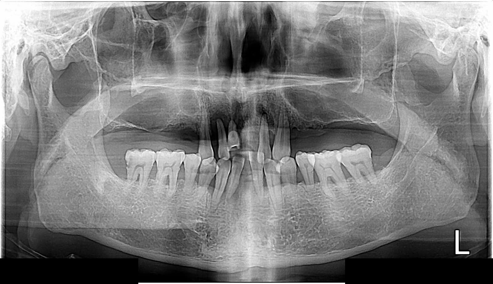 양산성모병원 치과 전악 임플란트 초진 파노라마 X-ray