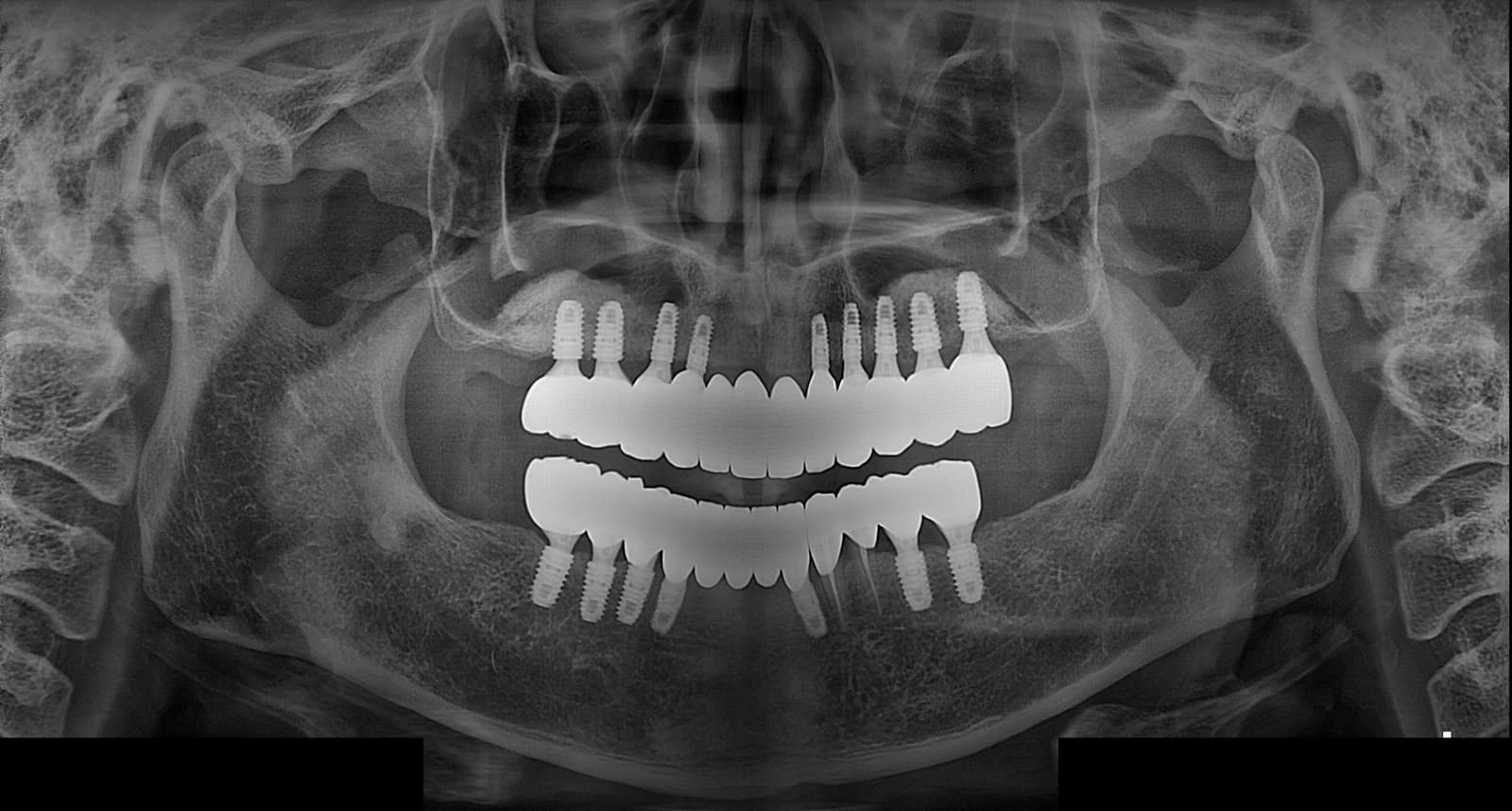 양산성모병원 치과 전악 임플란트 치료 완료 후 파노라마 X-ray