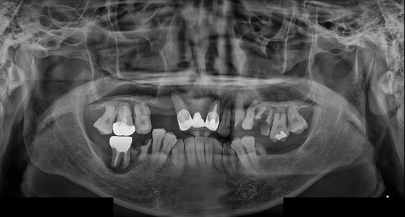 양산성모병원 치과 전악 임플란트 초진 파노라마 X-ray