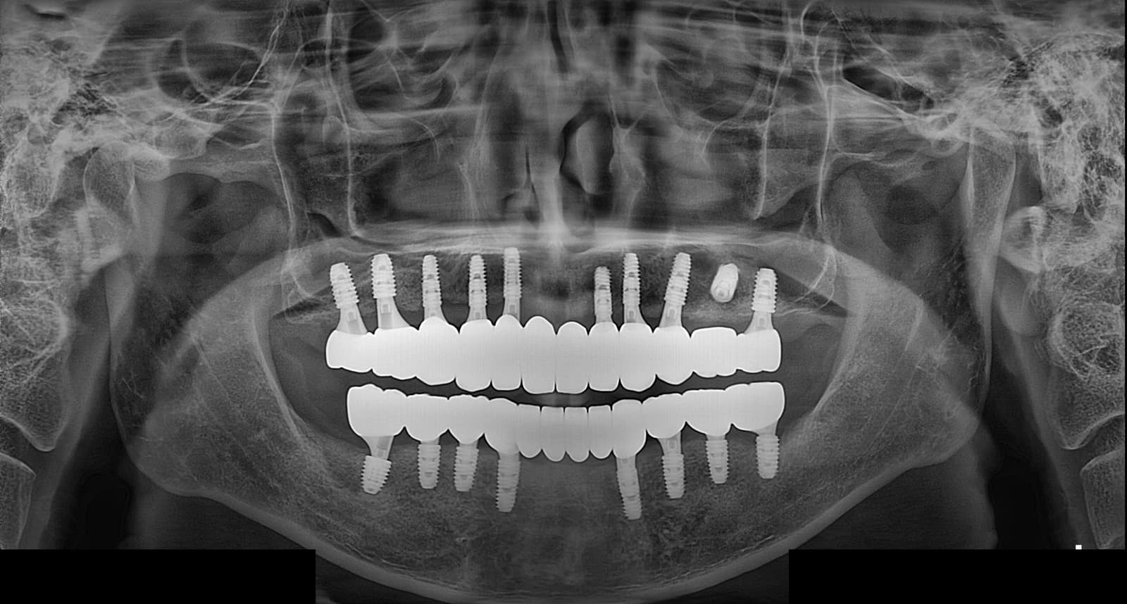 양산성모병원 치과 전악 임플란트 치료 후 파노라마 X-ray