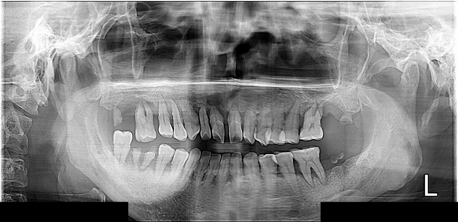 양산성모병원 치과 전악 임플란트 초진 파노라마 X-ray