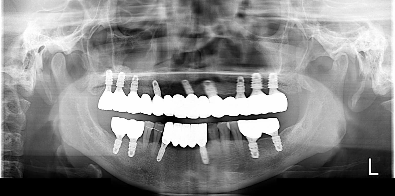 양산성모병원 치과 전악 임플란트 치료 후 파노라마 X-ray