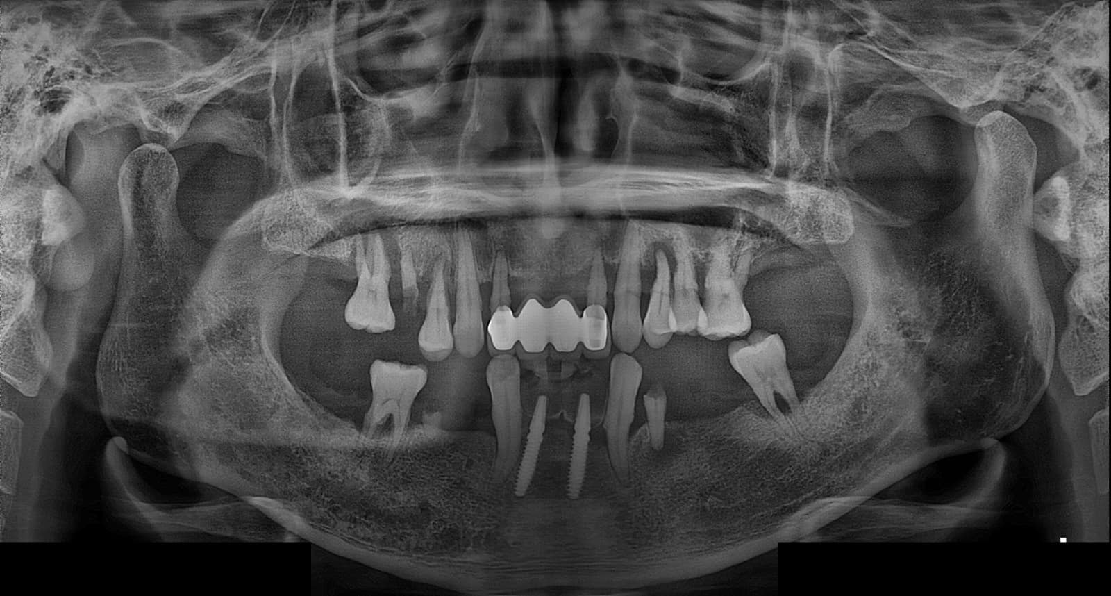 양산성모병원 치과 전악 임플란트 초진 파노라마 X-ray
