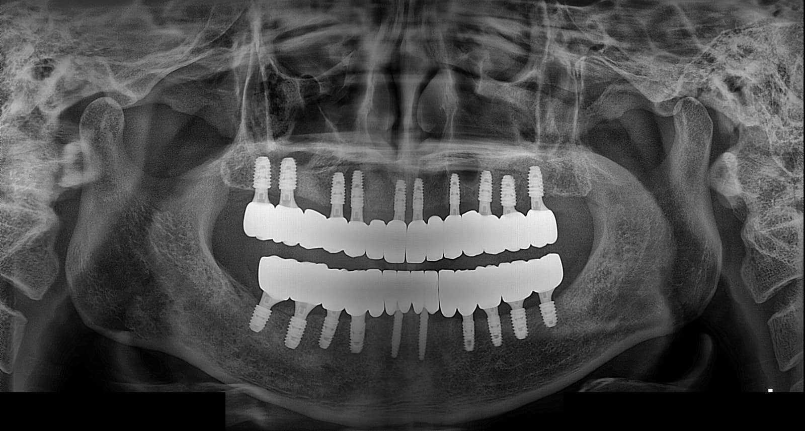 양산성모병원 치과 전악 임플란트 치료 후 파노라마 X-ray