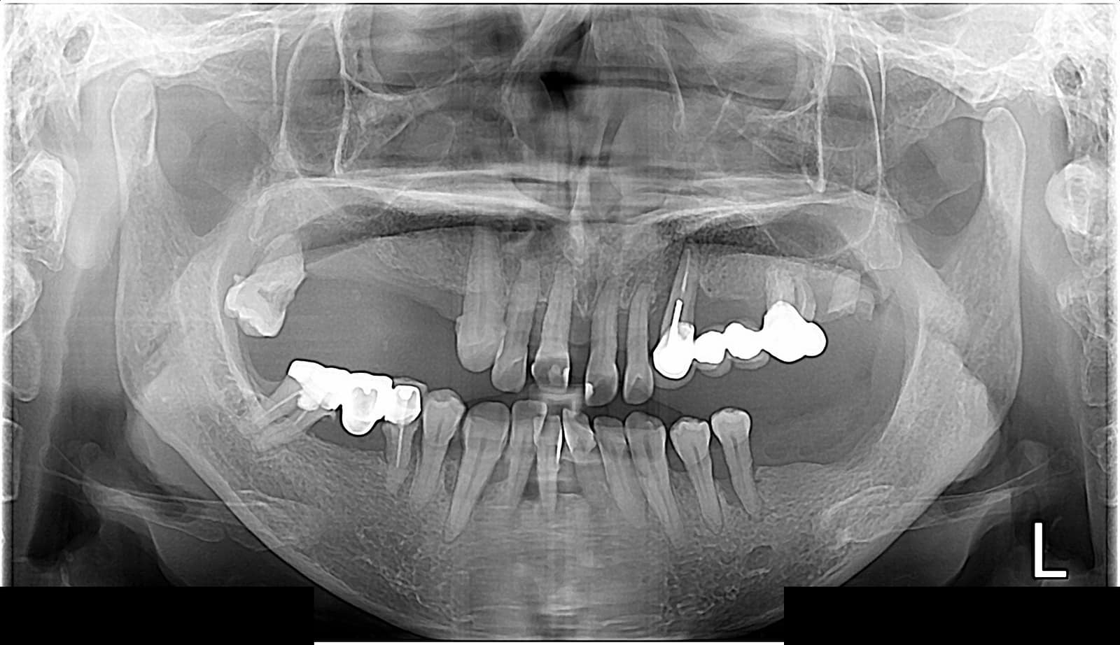 양산성모병원 치과 전악 임플란트 초진 파노라마 X-ray