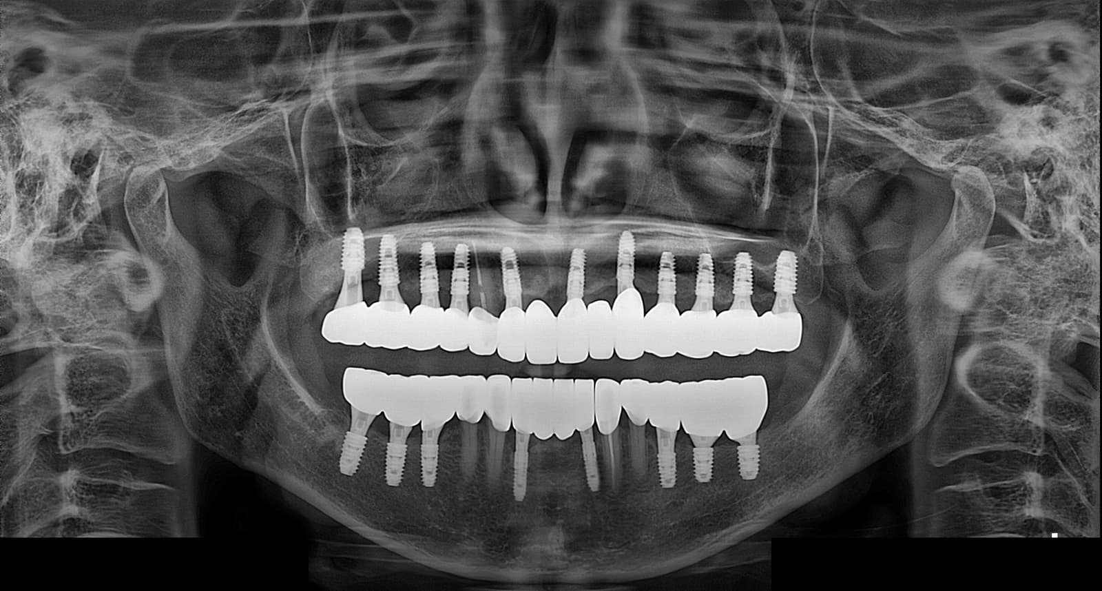 양산성모병원 치과 전악 임플란트 치료 후 파노라마 X-ray
